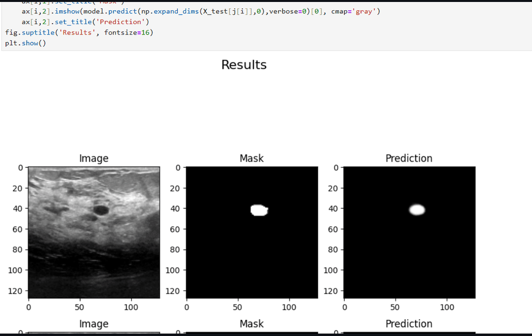 Breast Ultrasound Image Segmentation Using U-Net